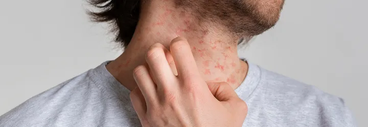 Eczema-Prone Skin: Tips on Good Skin Care