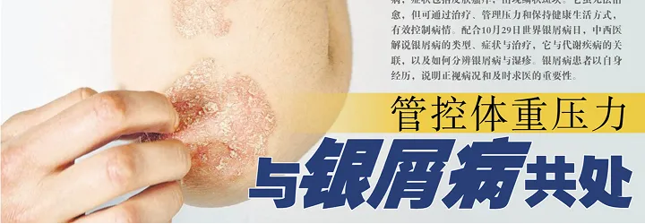Manage Weight and Stress: Living with Psoriasis (Interview by Lian He Zao Bao)