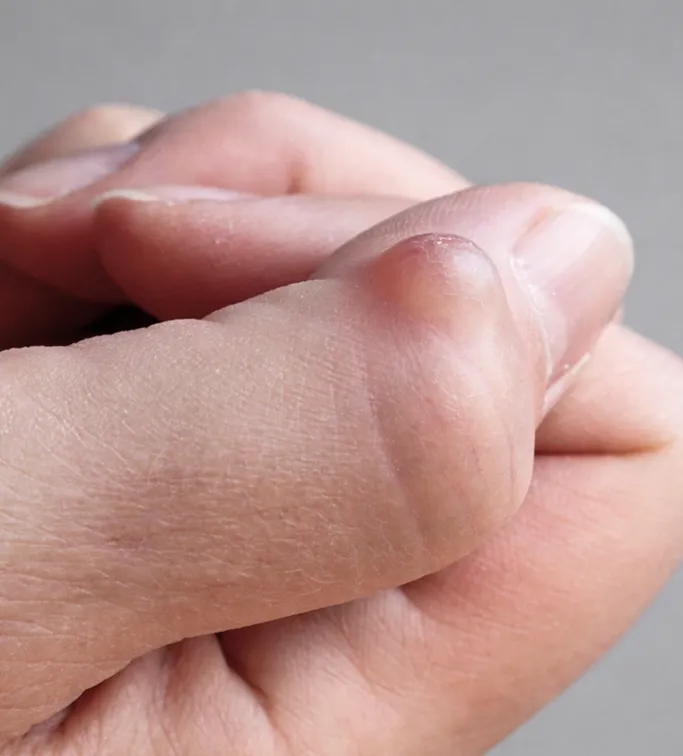 When Should You See a Dermatologist for Cysts?