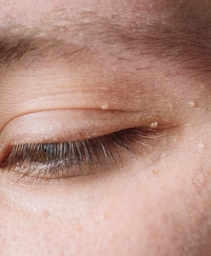 When Should You See a Dermatologist for Cysts?