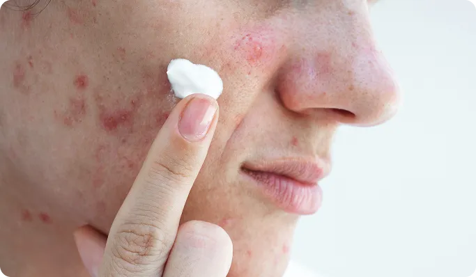 When Should You See a Dermatologist for Acne Scars?