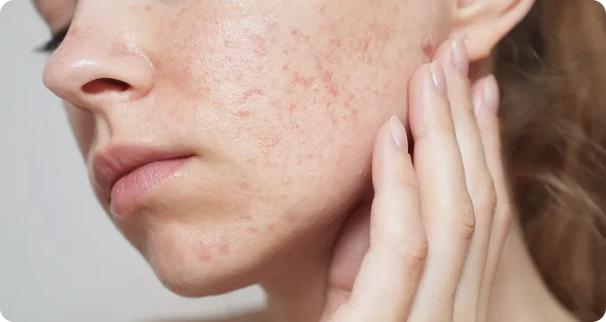 When Should You See a Dermatologist for Acne Scars?