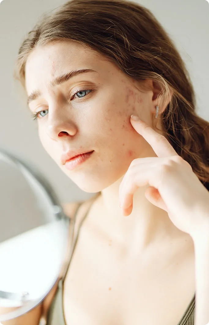 When Should You See a Dermatologist for Acne?