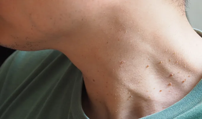 When Should You See a Dermatologist for Benign Skin Growths?