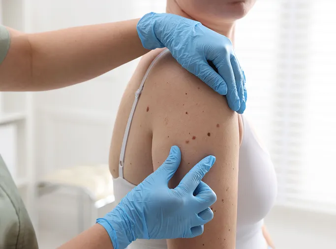 When Should You See a Dermatologist for Benign Skin Growths?