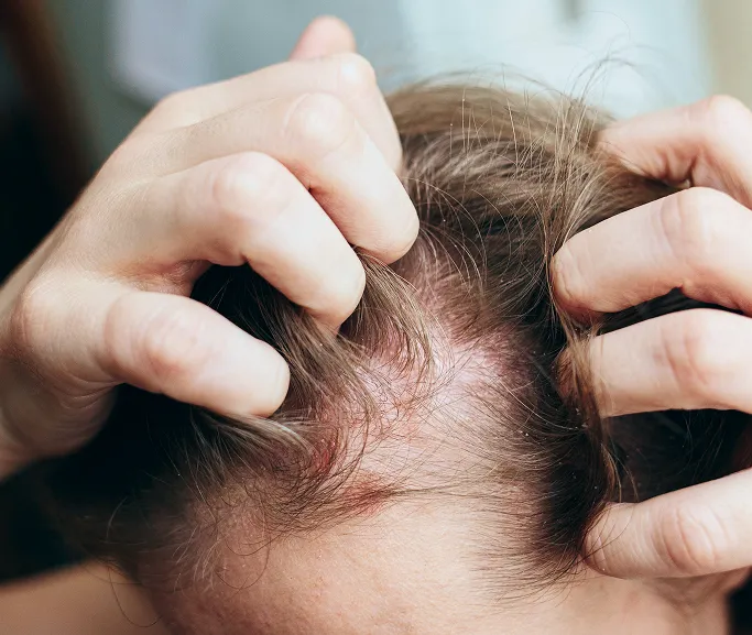 When Should You See a Dermatologist for Dandruff?