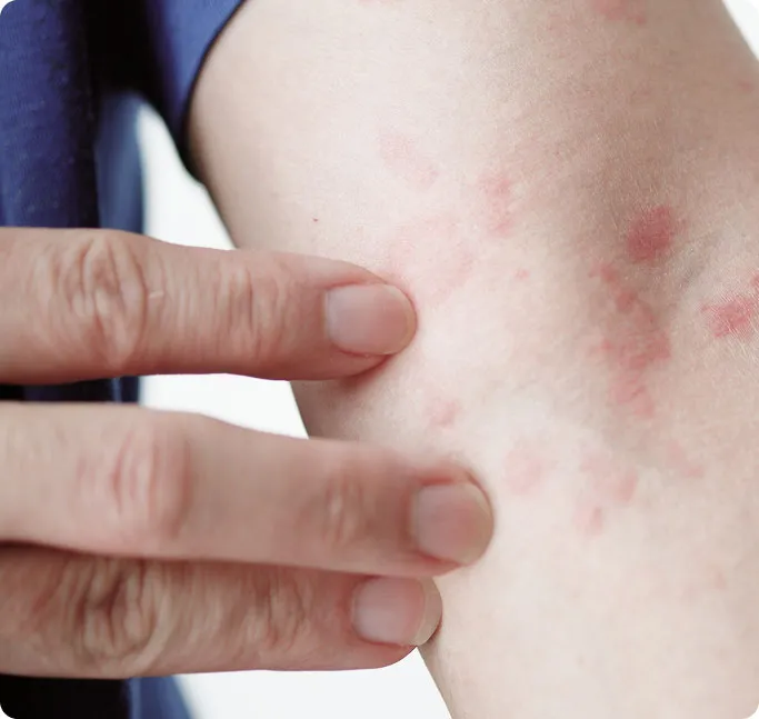 When Should You See a Dermatologist for Hives?