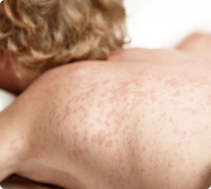 When Should You See a Dermatologist for Hives?