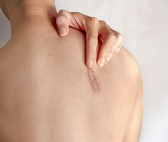 When Should You See a Dermatologist for Keloid Scars?