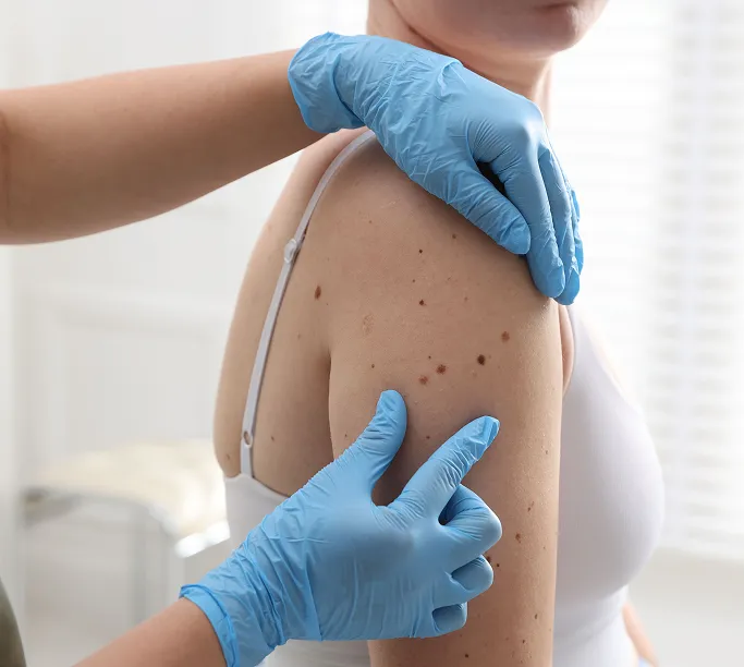 When Should You See a Dermatologist for a Mole?