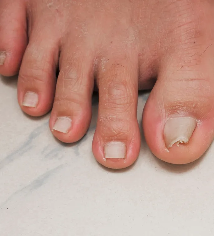 When Should You See a Dermatologist for Nail Conditions?