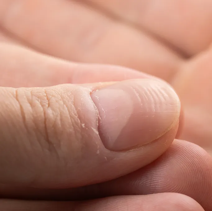 When Should You See a Dermatologist for Nail Conditions?