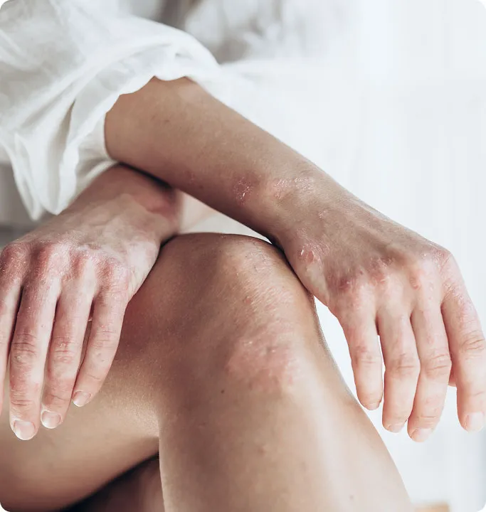 When Should You See a Dermatologist for Psoriasis?