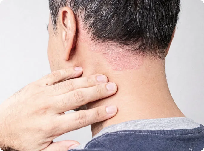 When Should You See a Dermatologist for Psoriasis?