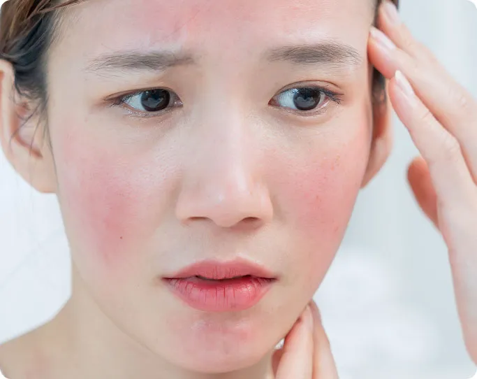 When Should You See a Dermatologist for Rosacea?