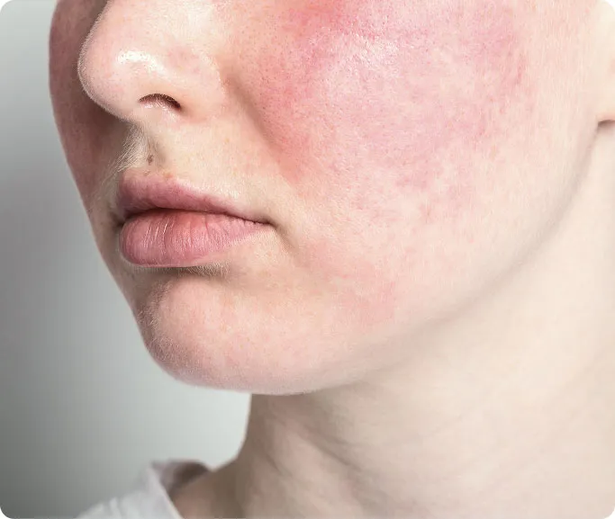 When Should You See a Dermatologist for Rosacea?