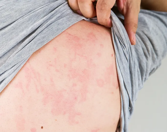 When Should You See a Dermatologist for Skin Allergies?