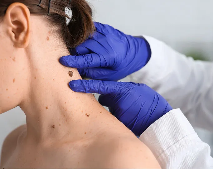 When Should You See a Dermatologist for Skin Cancer Screening?