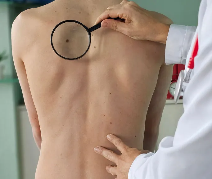 When Should You See a Dermatologist for Skin Cancer Screening?