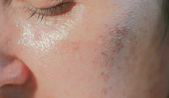 When Should You See a Dermatologist for Skin Pigmentation?