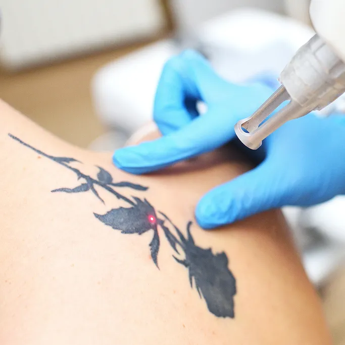 When Should You See a Dermatologist for Tattoo Removal?