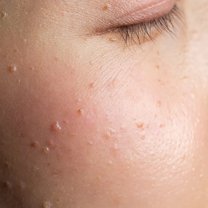 When Should You See a Dermatologist for Warts?