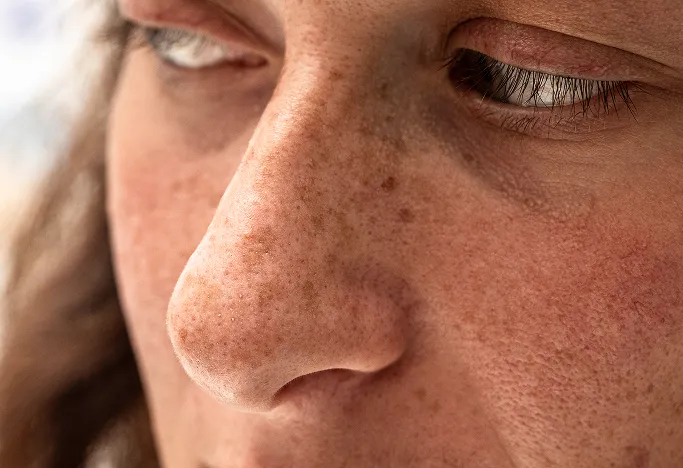 When Should You See a Dermatologist for Wrinkles?