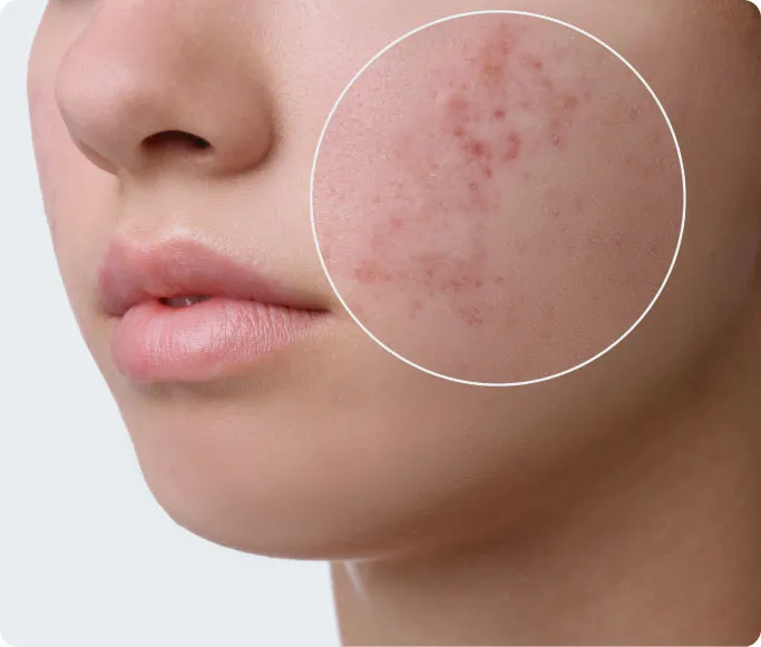 Common Symptoms of Acne to Look Out For