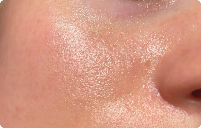 Common Symptoms of Acne to Look Out For