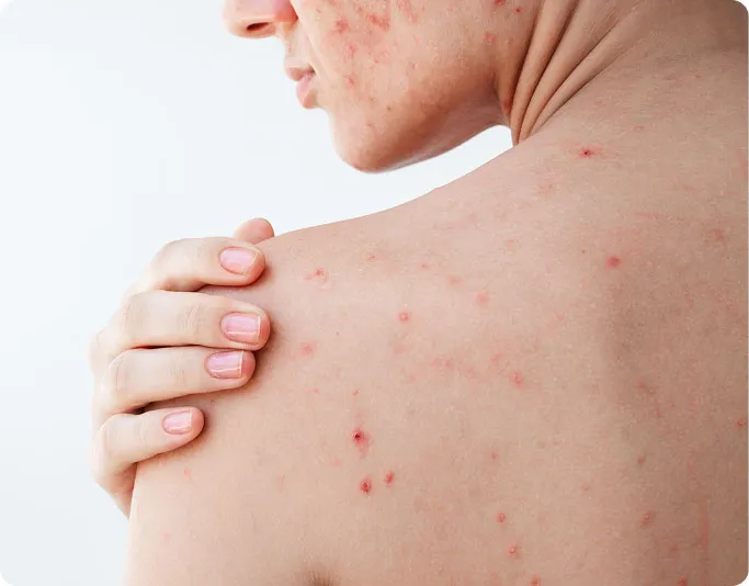 Common Symptoms of Acne Scars to Look Out For