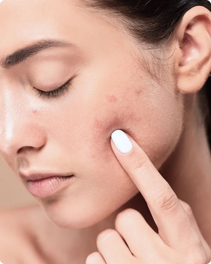 Common Symptoms of Acne Scars to Look Out For
