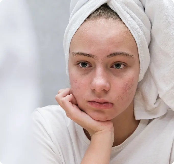 Common Symptoms of Acne Scars to Look Out For