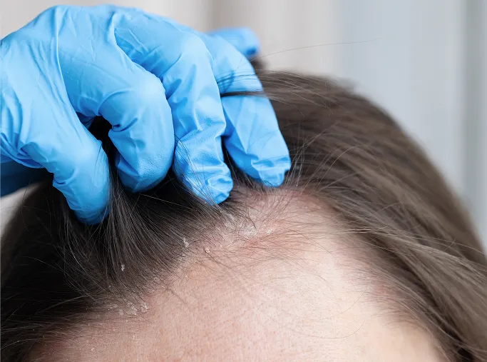 Common Symptoms of Dandruff to Look Out For