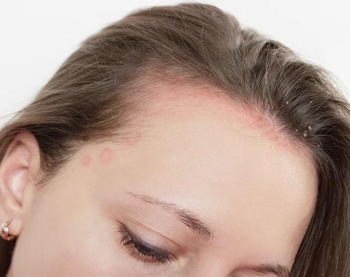 Common Symptoms of Dandruff to Look Out For