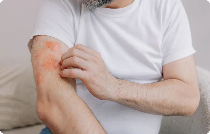 Common Symptoms of Eczema to Look Out For