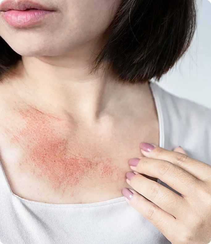 Common Symptoms of Hives to Look Out For