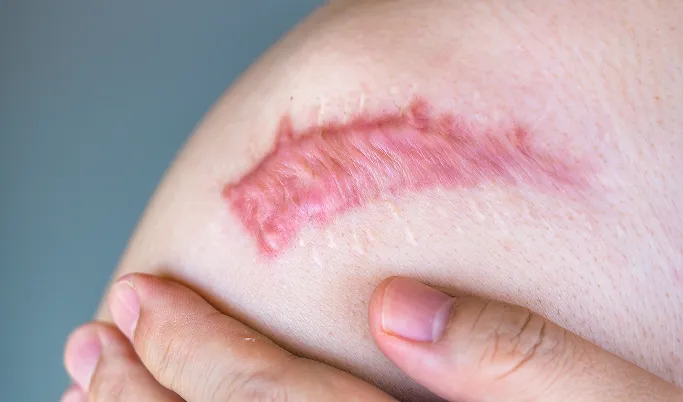 Common Symptoms of Keloids to Look Out For