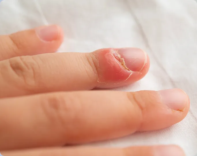 Common Symptoms of Nail Conditions to Look Out For