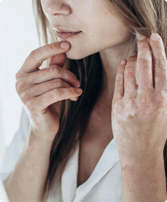 Common Symptoms of Psoriasis to Look Out For