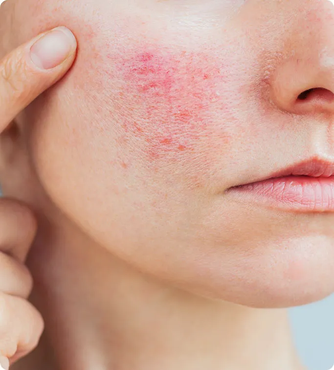 Common Symptoms of Rosacea to Look Out For