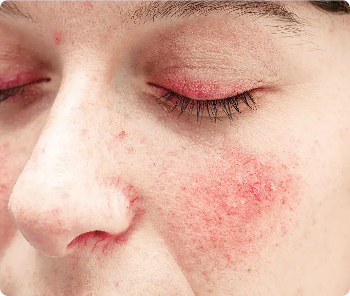Common Symptoms of Rosacea to Look Out For