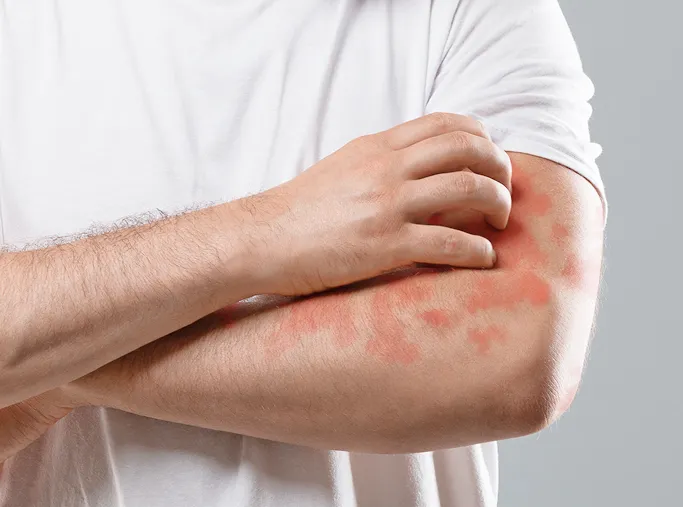 Common Symptoms of Skin Allergies to Look Out for