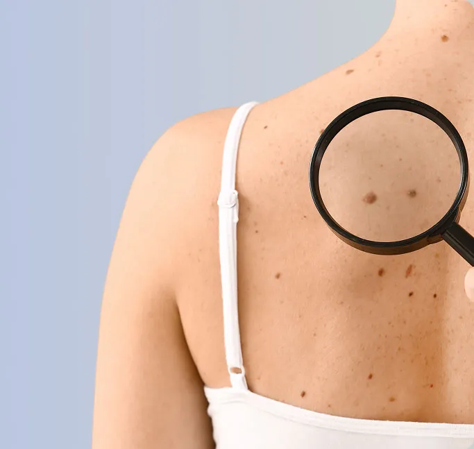 Common Symptoms of Skin Cancer to Look Out For