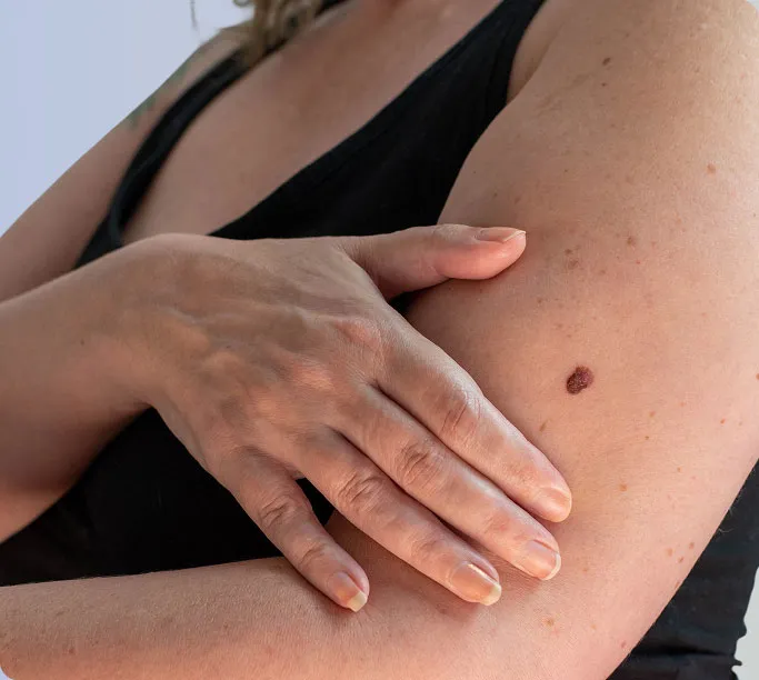 Common Symptoms of Skin Cancer to Look Out For
