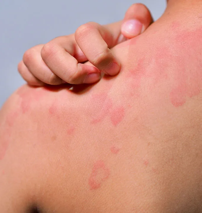 Common Symptoms of Skin Infections to Look Out For