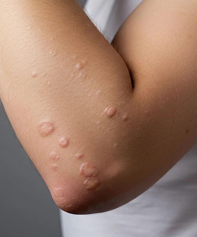 Common Symptoms of Skin Infections to Look Out For