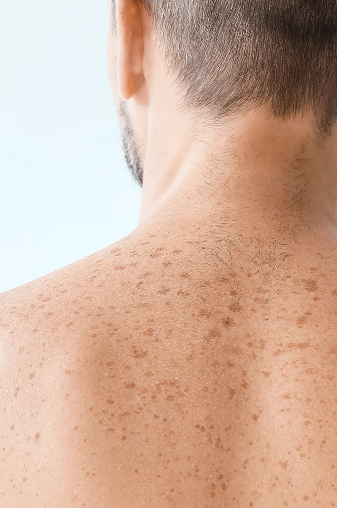 Common Symptoms of Skin Pigmentation to Look Out For