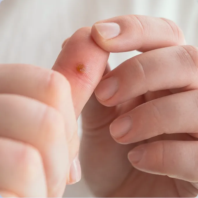 Common Symptoms of Warts to Look Out For