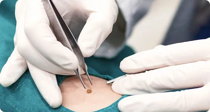 Common Types of Skin Cancer Surgery