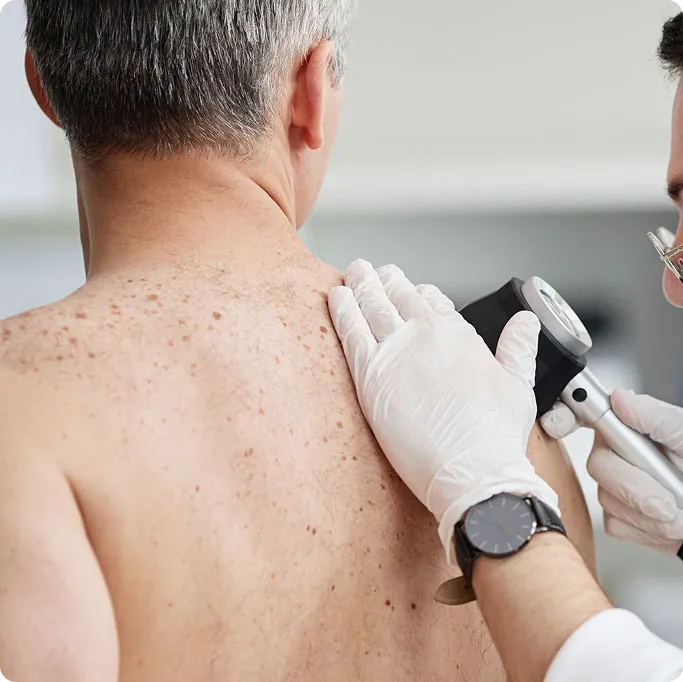 Understanding Skin Cancer